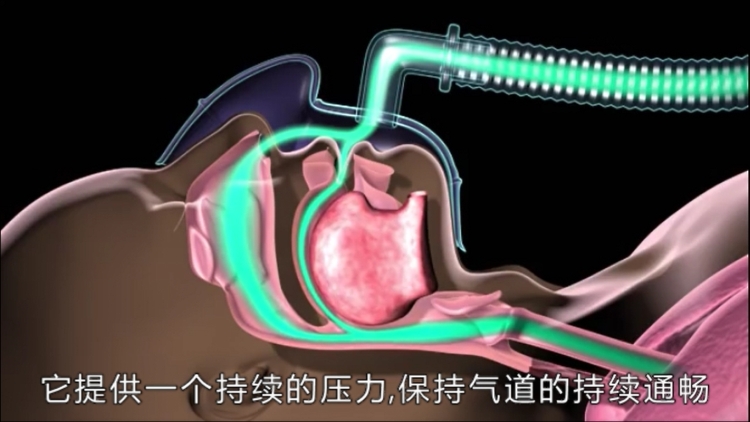 【宁波呼吸机专卖】二氧化碳潴留的治疗