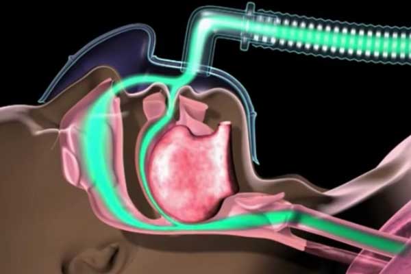 家用呼吸机选购全攻略（买呼吸机必看）