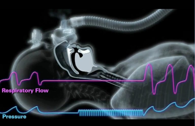 有一种呼吸暂停叫：中枢型睡眠呼吸暂停（CSA）